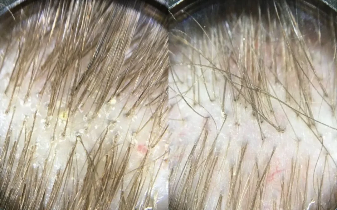 Dermabrasion in salon scalp treatment